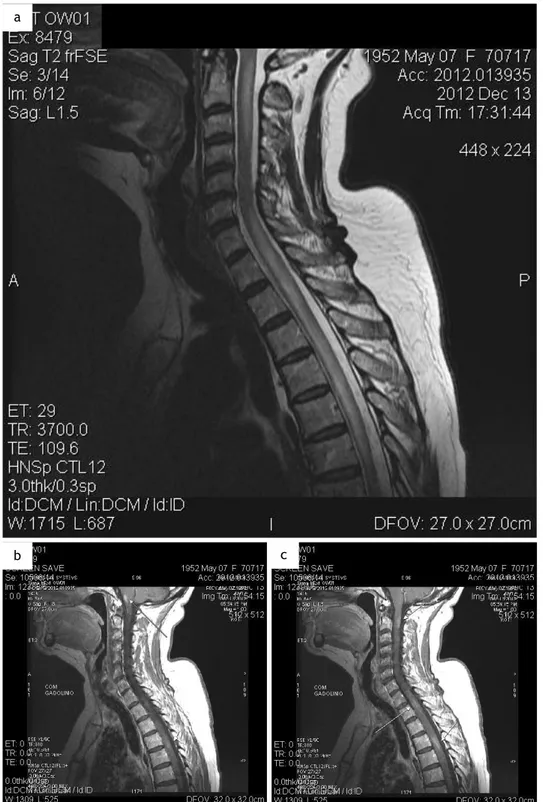 Figura  10  –  RMN  vertebro-medular  cervical  (13/12/2012).  a.  Em  T2.  b.  Em  T1  com  gadolínio