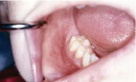 Figura 5: Lesão oral específica: ulcerações profundas e lineares no fundo do vestíbulo (Rowland, Fleming and Bourke,  2010) 