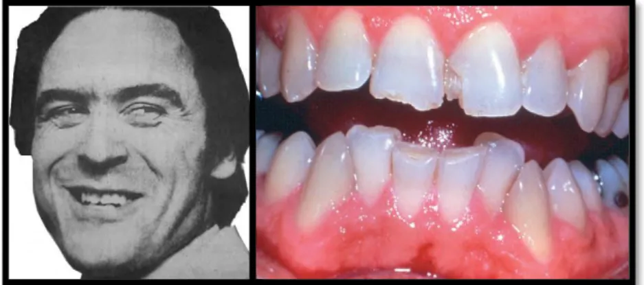 Figura 1 – Theodore Bundy e sua fotografia intraoral, (Fonte: Silver, W. F. e Souviron, R., 2009)