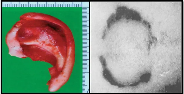 Figura 4 – Orelha humana avulsionada por uma mordida e marca de mordida no ombro de uma vítima de  homicídio, (Fonte: Whittaker, D., 2004 e Vale, G.L