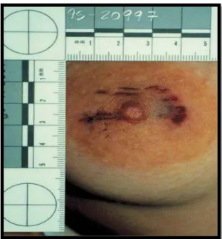 Figura 5 – Marca de mordida humana com abrasões, (Fonte: Sweet, D. e Pretty, I. A., 2001)