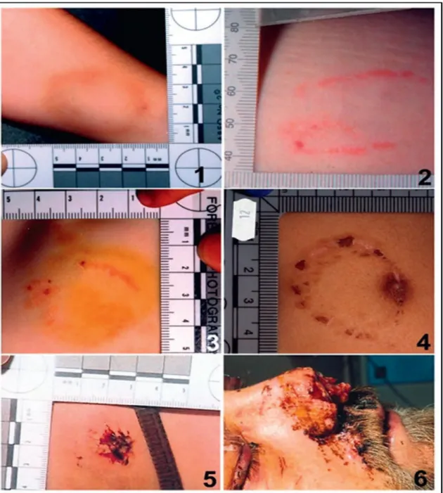 Figura 6 – Ilustração dos vários níveis de gravidade de uma marca de mordida, desde uma leve contusão  (1) até à avulsão de tecidos (6), (Fonte: Bowers, C