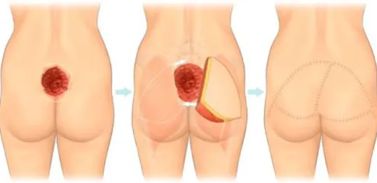 Figura 10. Flap reconstruction. Retirado de [37]. 