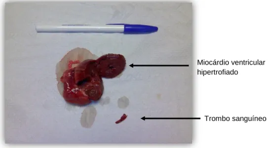 Figura 1 – Coração de gato com CMH e tromboembolismo arterial (cedido por Dr. Rui Máximo,  2010) 