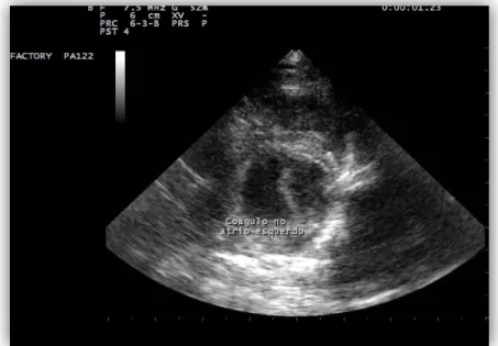 Figura 9 – Imagem ecocardiográfica de um coágulo sanguíneo localizado no átrio esquerdo  (cedido por Dr.Rui Máximo, 2010) 