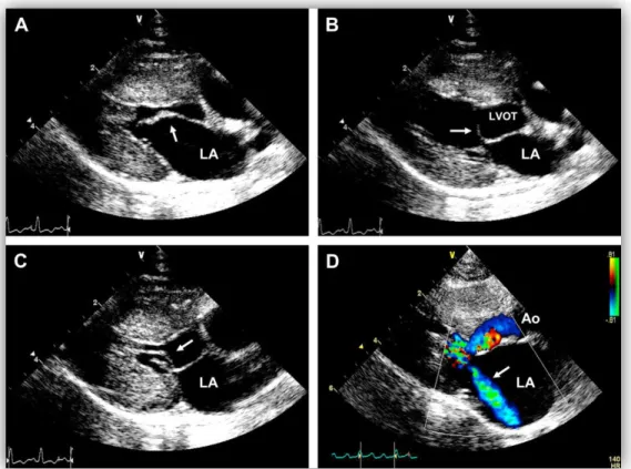 Figura 10 – Imagens ecocardiográficas em modo bidimensional e Doppler a cores (vista  paraesternal direita) de um gato com CMH e hipertrofia ventricular esquerda severa (Shober &amp; 