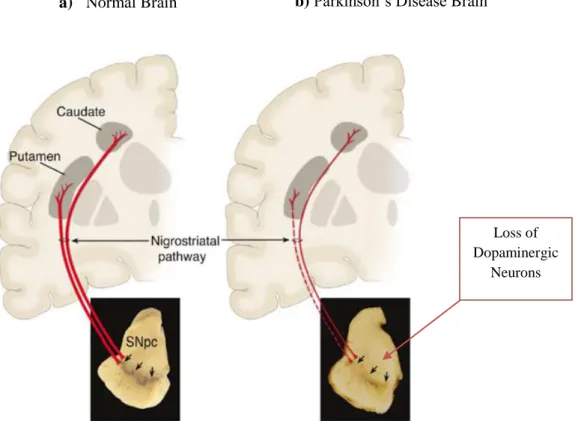 Figure 2: Neuropathology of PD a) Schematic representation of the normal nigrostriatal pathway (in red)