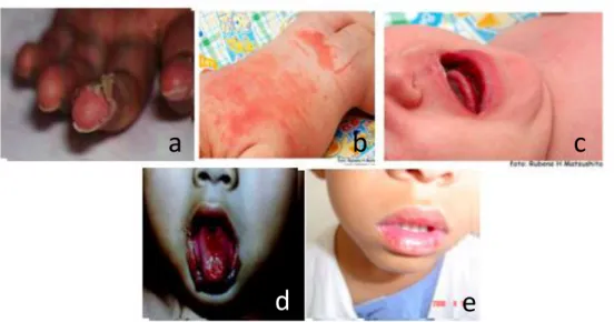 Figura 2 – Principais manifestações clinicas da DK (a) descamação periungueal dos dedos das  mãos (b) Exantema polimorfo (c) Alterações em lábios e cavidade bucal  (d) língua em 