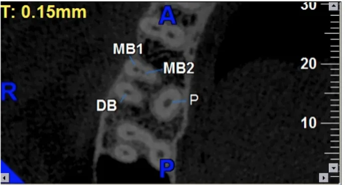 Ilustração 1 – Tomografia computorizada de feixe cónico (corte axial) do primeiro  molar maxilar (1.6) mostrando presença do segundo canal mesiovestibular 