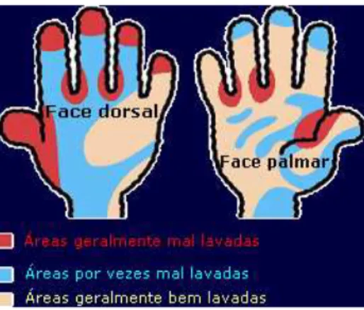 Figura 2.  Áreas das mãos que facilmente ficarão bem ou mal lavadas (Taylor, 1978 citado por  Baptista &amp; Saraiva, 2003) 