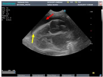 Figure 19 CTS view during Spike TFAST. Presence of  URLs  (yellow  arrow)  and  the  glide  sign  was  also  present