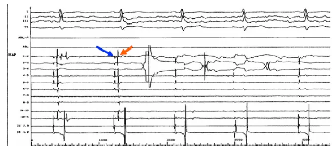 Figure  3. Ablation  at  the  ostium  of  the  left  superior  pulmonary  vein.  A  circumferential  mapping  catheter positioned at the ostium records left atrial potentials (indicated by blue arrow) and pulmonary  vein  potentials (indicted  by  red  arr