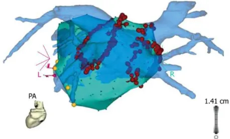 Figure 4 .  The blue 3D anatomical shell of the left atrium and the pulmonary veins, as acquired by pre- pre-procedural  computed  tomography,  is  merged  with  the  grey  anatomical  shell  that  is  constructed  with  electro-anatomical  mapping  during