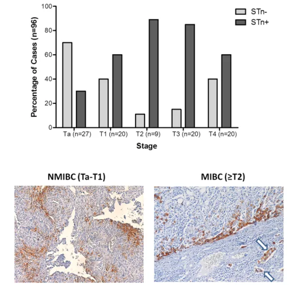 Fig 3. STn expression in different bladder tumors stages. (A) Distribution of STn negative and positive tumors along the different stages of bladder cancer; (B) Representative images of STn staining in NMIBC and MIBC