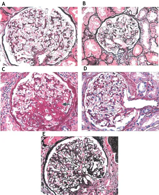 Figura  3  -  Características  histológicas  da  GAO. A  –  os  doentes  apresentam  glomérulos  hipertrofiados  quando  comparados  com  B  -  glomérulos  de  doentes  não  obesos;  C  –  lesões  de  esclerose  segmentares 
