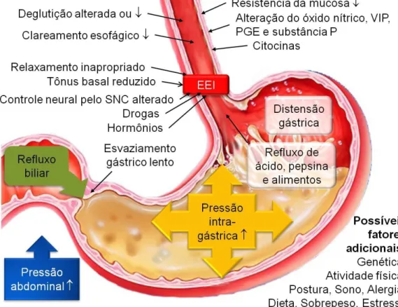 Figura 1 – Mecanismos fisiopatológicos da doença do refluxo gastroesofágico 