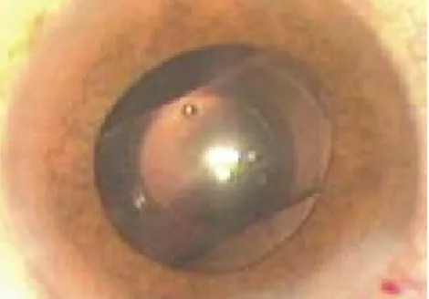 Figura 5) Paciente n° 21, 62 anos,                Figura 6) Mesmo paciente da figura 5  olho D,  pós-facoemulsificação