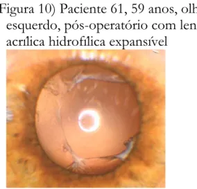 Figura 9) Paciente 47, 65 anos, olho          Figura 10) Paciente 61, 59 anos, olho  direito, pós-operatório  com lente   esquerdo, pós-operatório com lente  acrílica hidrofílica expansível  acrílica hidrofílica expansível 