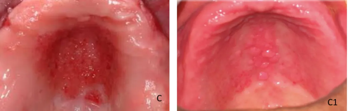 Figura 2 – Aspectos clínicos da mucosa palatina de acordo com a classificação de Newton Tipo  I: inflamação localizada ou hiperemia puntiforme (A, A1), Tipo II: eritema difuso (B, B1) e Tipo  III: hiperplasia papilar (C, C1)