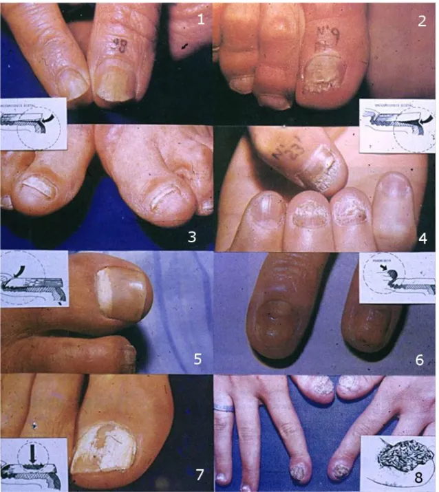 Figura  2  –  Aspectos  clínicos  dos  diferentes  tipos  de  onicomicose:  onicomicose  subungueal  distal  lateral  (1-4);  onicomicose  subungueal  proximal  (5);  distrofia  ungueal  associada  à  paroníquia  crônica  (6); onicomicose superficial branc