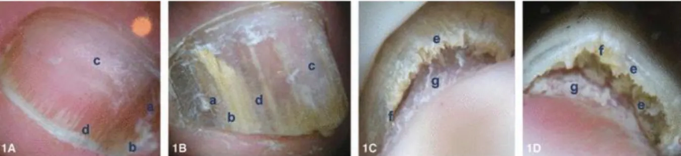 Figura 3 – Sinais dermatoscópicos ungueais. Onicomicose (1A-1D); lâmina ungueal (dorso) (1A-1B); 