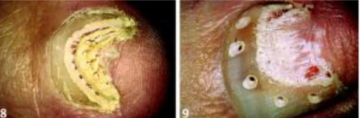 Figura 9 – Tratamento da onicomicose com uso do LASER de Er:YAG segundo técnica descrita por  FOSS, 2005