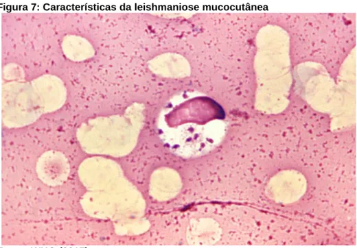 Figura 7: Características da leishmaniose mucocutânea 