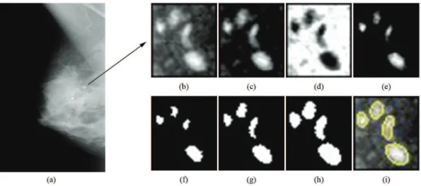 Figure 1.  (a) Medium lateral oblique view of a digital mammogram and a selected ROI (white square selected by a radiologist in the  mammogram)