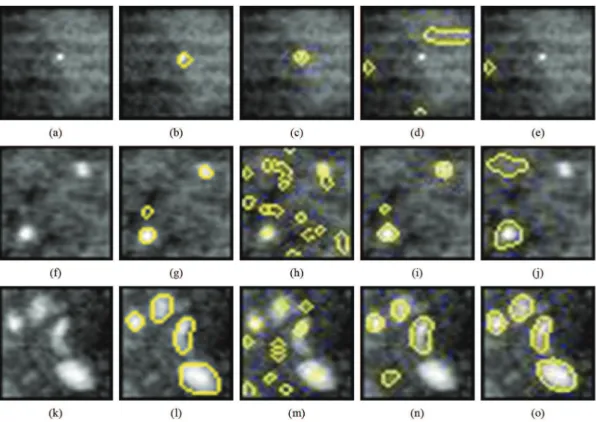 Figure 2. (a), (f) and (k) Original ROIs. (b), (g) and (l) their respective microcalciications manually delineated by the most experienced  radiologist