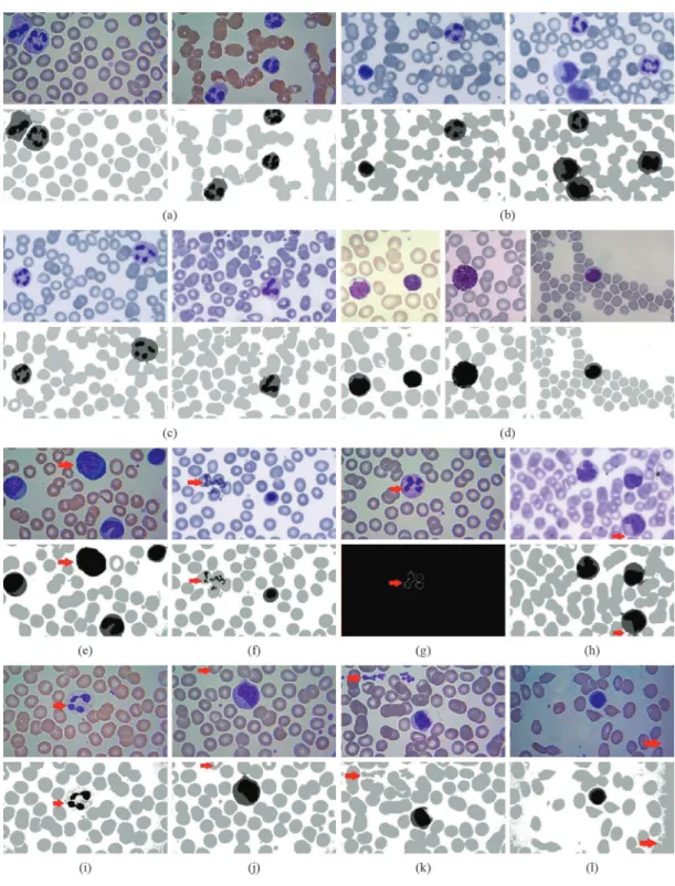 Figure 5. Examples of images before and after processing using the proposed method with a high level of independence from the hematological  staining technique used on the sample: a) Fast Panoptic (G1), b) Leishman (G2), c) Rosenfeld (G3) and d) unspeciied