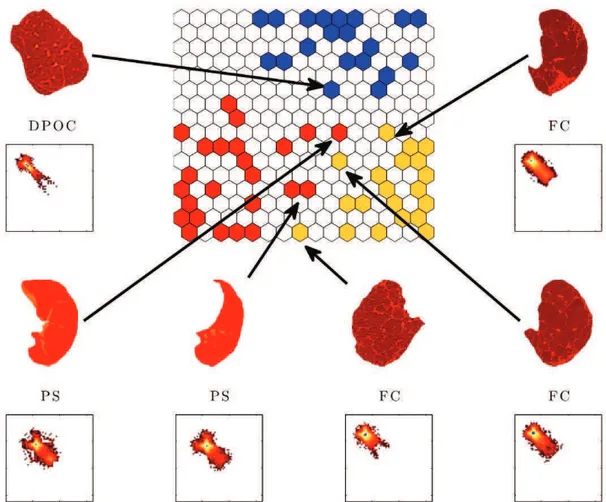 Figure 4. Lung images on the class boundaries. The colors in the U-Matrix identify the classes HL (red), PF (yellow) and COPD (blue).