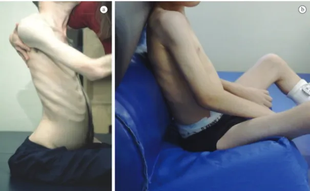 Figure 2. (a) Child with a forward pelvic tilt and (b) child with appropriate pelvic position after placing a posterior wedge