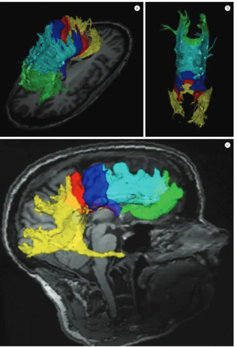 Figure 8. Tractography results for a single subject overlaid in the midsagittal slice of the brain in the T1-weighted MRI.