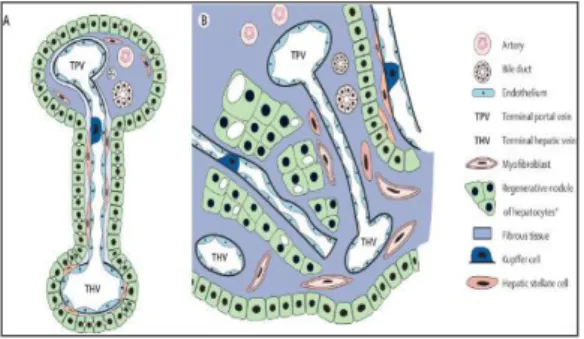 Fig. 4 . Vascular and architectural alterations in cirrhosis  Mesenteric blood flows via the portal vein and the hepatic artery  that extend branches into terminal portal tracts