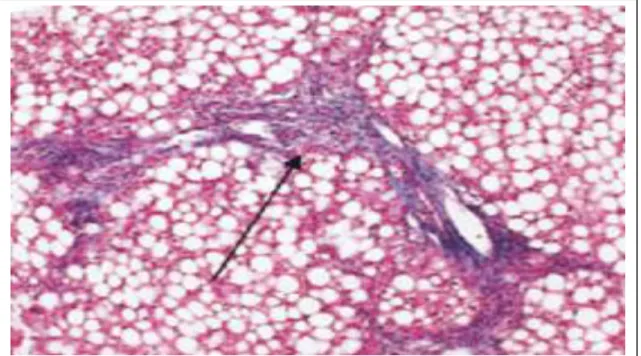 Figura 6. Fibrose portal e esteatose. Alterações vistas na EHNA tipo 2. 