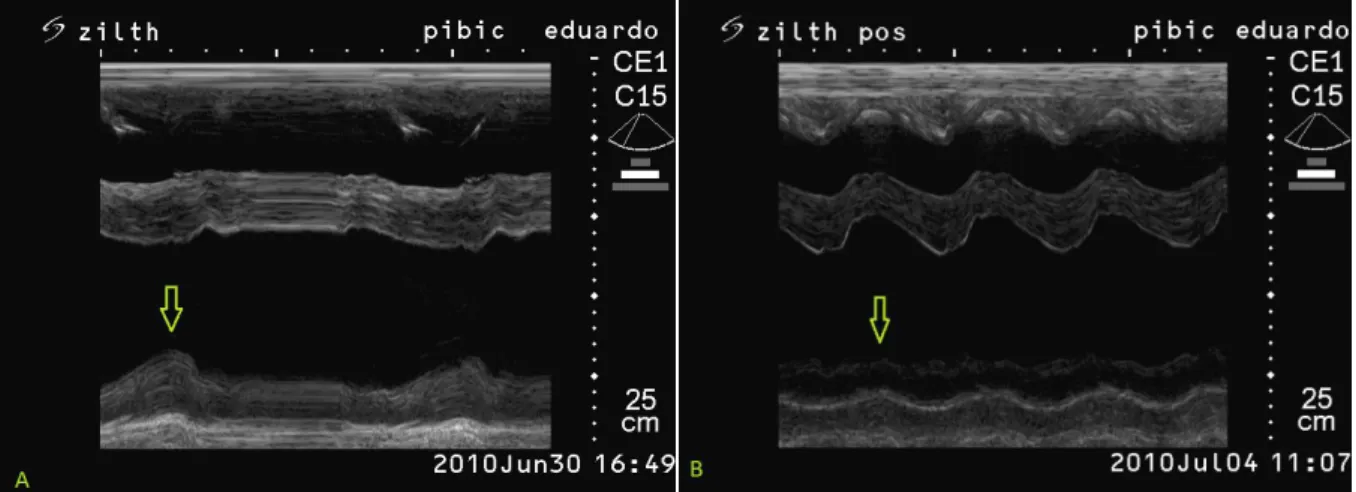 Figura 1. A: Imagem ecocardiográfica em modo M referente ao M 0  com seta indicando a parede livre do  ventrículo  esquerdo  em  sístole  normocinética
