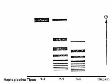 Figura 2: Padrões típicos de migração da haptoglobina dos fenótipos Hp  1-1,  Hp 2-1, Hp  2-2, em gel de amido (Langlois e Delanghe, 1996)