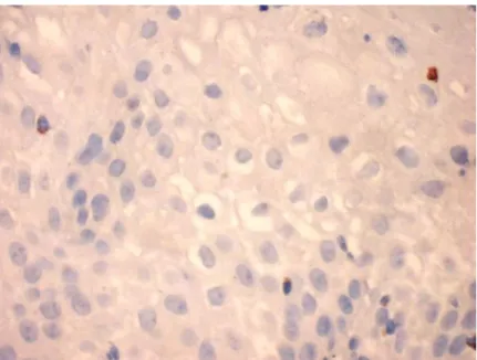 Figura 1- Fotomicrografia evidenciando linfócitos positivos para a granzima B em  corte histológico de Imuno-histoquímica (HPF 400X) de LIEBG do grupo controle 
