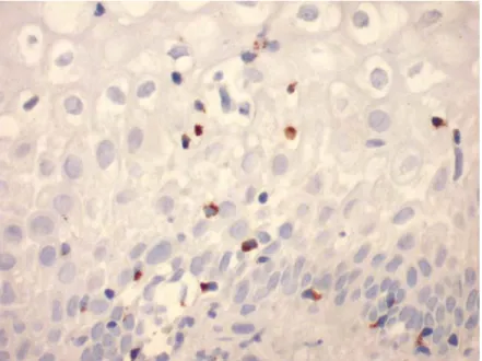 Figura 3- Fotomicrografia evidenciando linfócitos positivos para a granzima B em  corte histológico de Imuno-histoquímica (HPF 400X) de LIEBG do grupo  HIV-positivo 