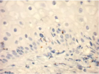 Figura 5- Fotomicrografia evidenciando linfócitos positivos para a granzima B em  corte histológico de Imuno-histoquímica (HPF 400X) de cervicite leve do grupo  HIV-positivo 