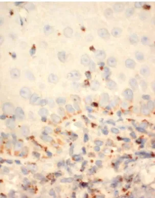 Figura 7- Fotomicrografia evidenciando vários linfócitos positivos para a granzima  B em corte histológico de Imuno-histoquímica (HPF 400X) de cervicite aguda do  grupo HIV-positivo 