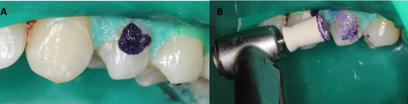 Figura 16 – Aplicação do Opalustre® da Ultradent 