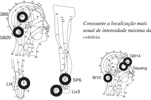 Figura 7 - Possíveis locais de inserção - bilateralmente - das agulhas de acupunctura