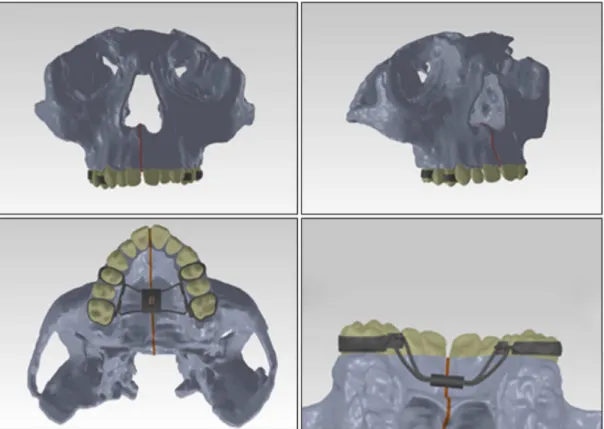 Figure 2. Complete 3D model with palatal expander ixed to posterior teeth (in light gray: bone; dark gray: palatal expander/steel; beige: 