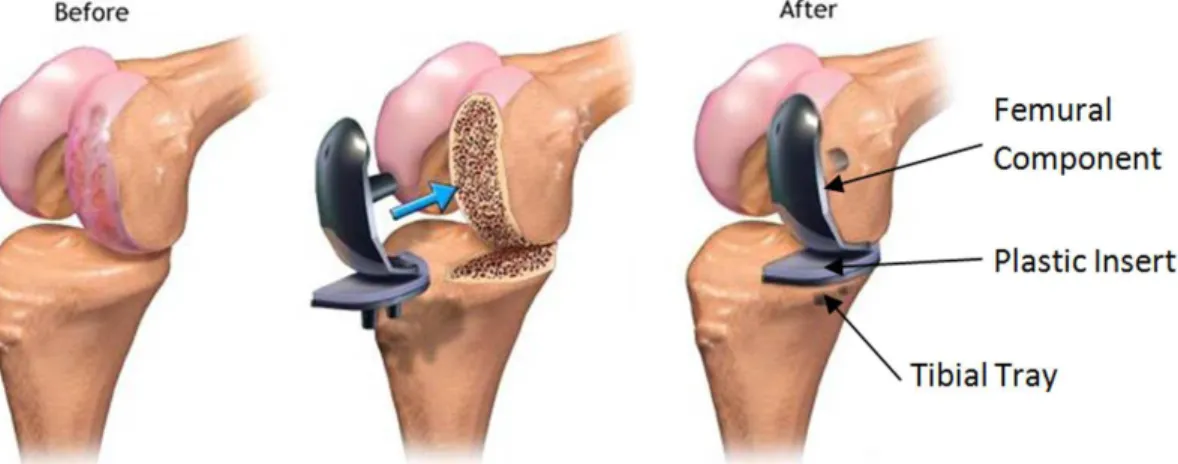Figure 2. Unicondylar knee Arthroplasty using standard designs (Eksteen and Van der Merwe, 2012).