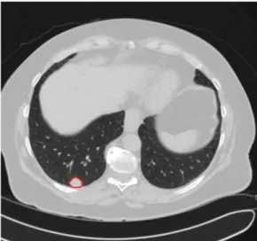 Figure 2. Example of a marking on a CT slice.