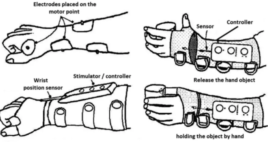 Figure 2.  Neuroprosthesis Bionic Gloves  . This system is a ingerless glove and an extension as forearm