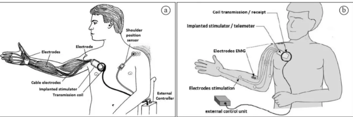 Figure 3. Freehand   system. These systems consist of stimulators implanted in the user’s chest