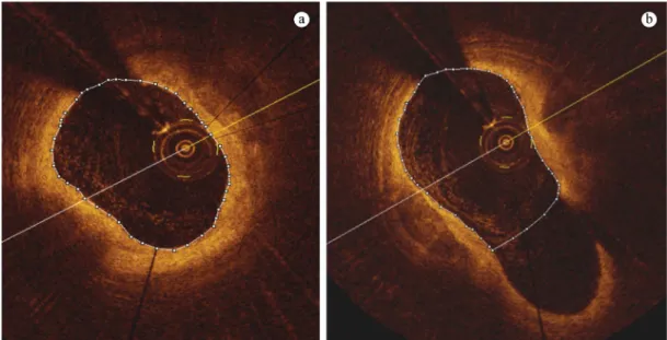 Figure 4. Examples of manual segmentation: (a) Frame outside a bifurcation region; (b) Frame inside a bifurcation region with a manual  correction prioritizing the main branch.
