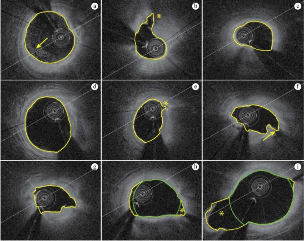Figure 6. Examples of the proposed automatic segmentation (yellow line): (a) Residual blood in the vessel lumen area (arrow); (b) Artery  dissection (asterisk); (c) Severe stenosis; (d) Regular slice; (e) Artery dissection (asterisk); (f) Complex plaques w